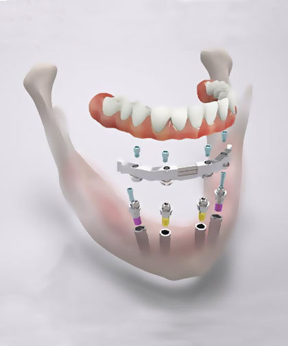 Фото зубного импланта