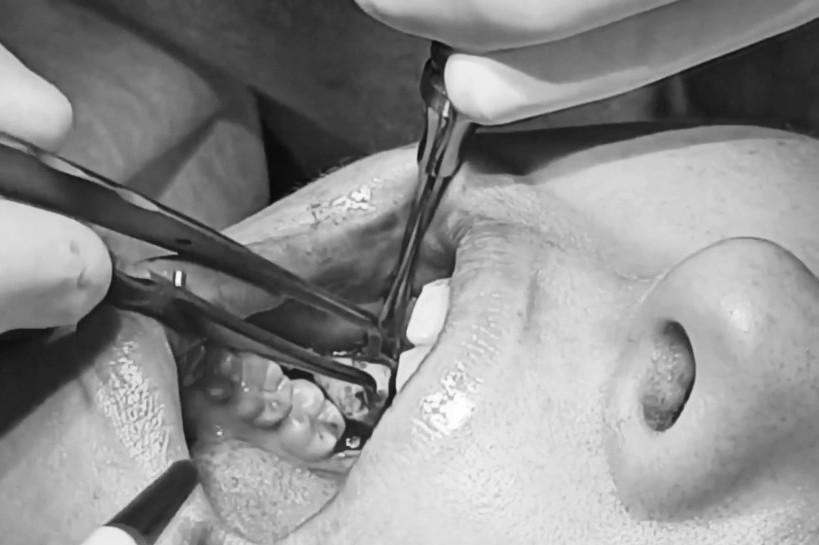 Фото зубного импланта