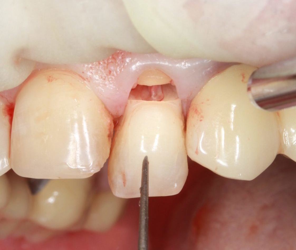 Dentist is checking up a patient with an ortodental system