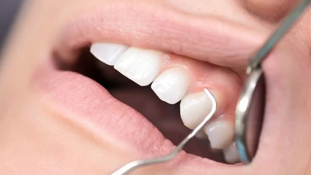 кюретаж пародонтальних кишень