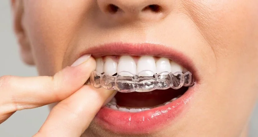 системы invisalign