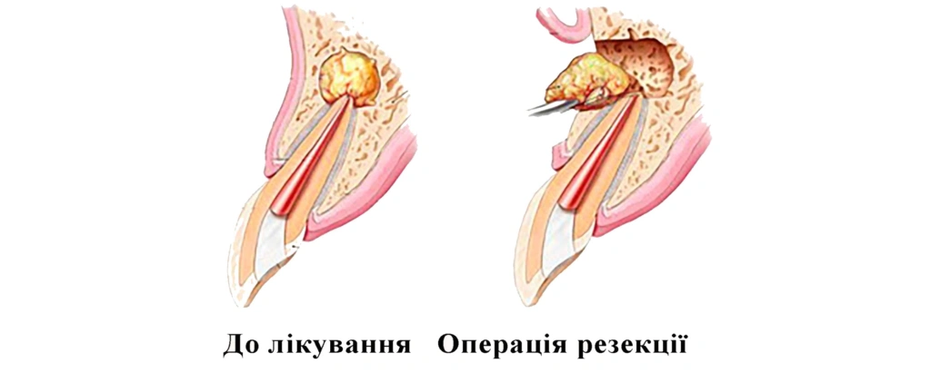 резекція зуба